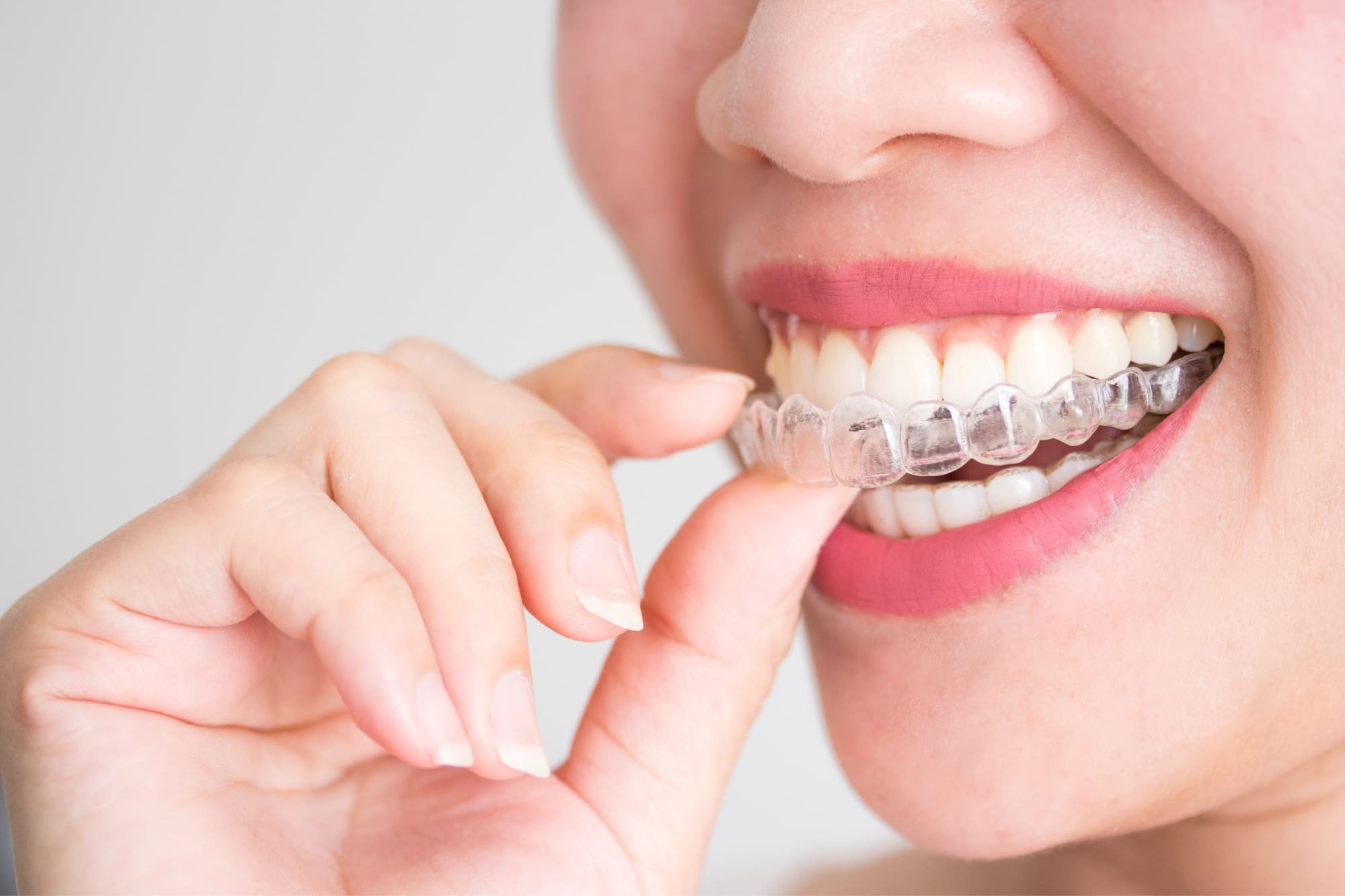 ortodoncia invisalign - ¿Necesito ortodoncia?