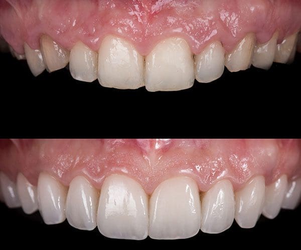 Diseño de sonrisa. Casos reales, antes y después 3 Diseño de sonrisa. Casos reales, antes y después. Caso 2