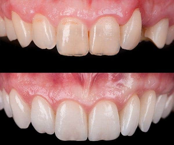 Diseño de sonrisa. Casos reales, antes y después 4 Diseño de sonrisa. Casos reales, antes y después. Caso 3