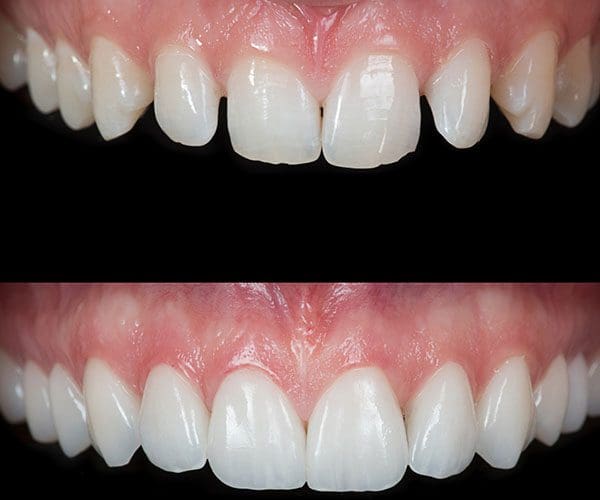 Diseño de sonrisa. Casos reales, antes y después 2 Diseño de sonrisa. Casos reales, antes y después. Caso 1