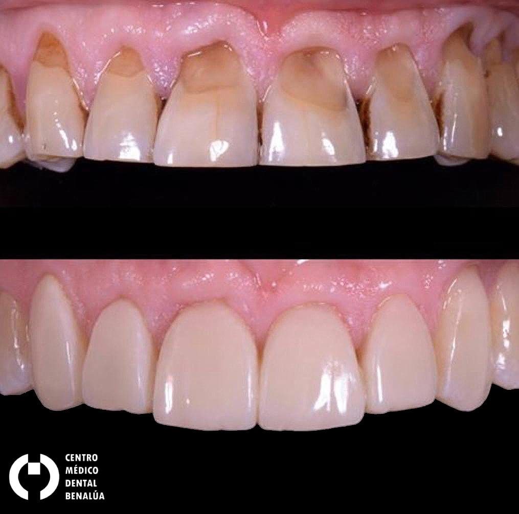 estetica dental antes y despues de tratamiento