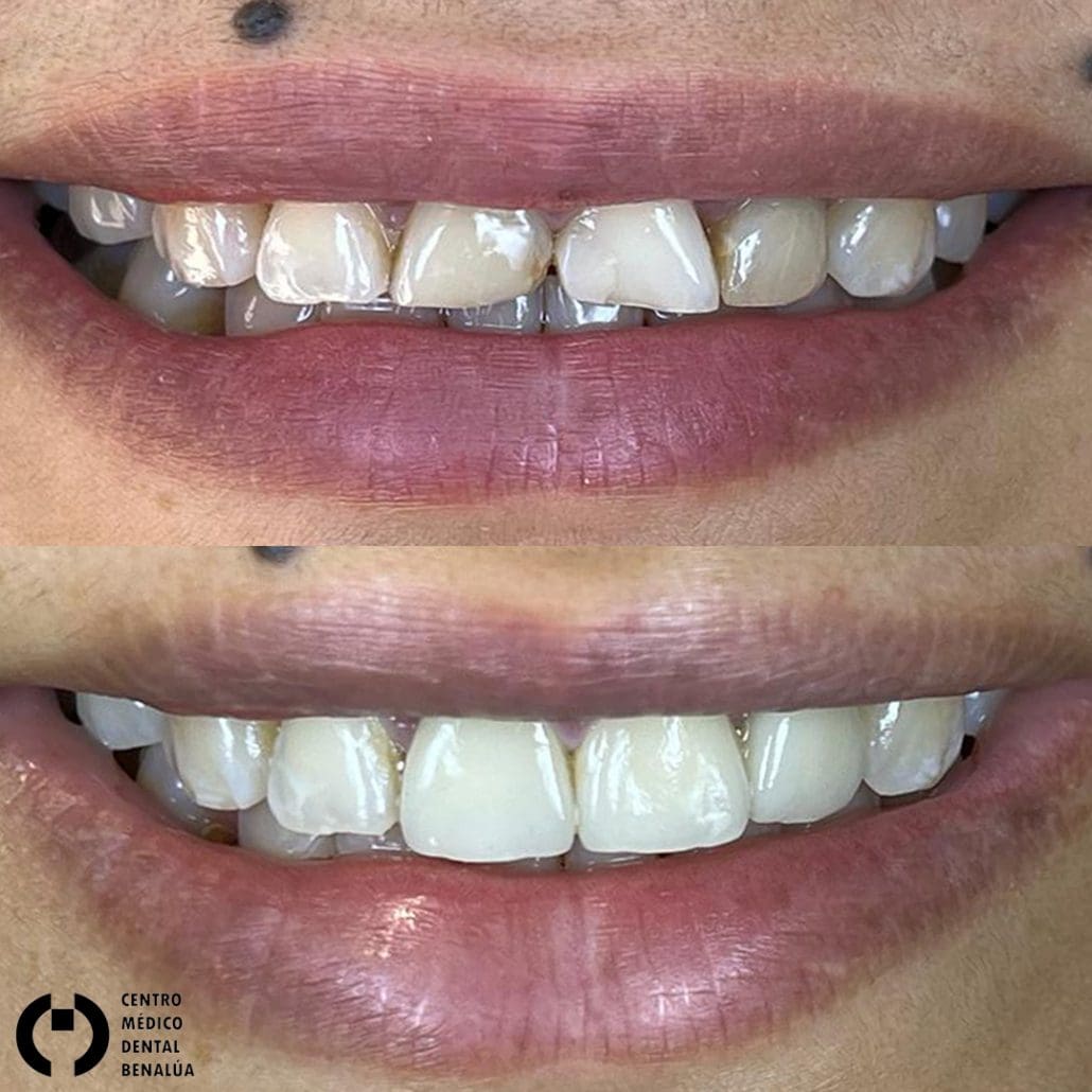 estetica dental antes y despues en clinica dental