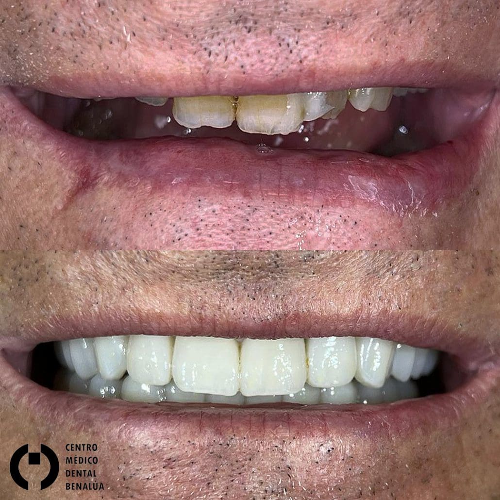 estetica dental antes y despues paciente en clinica dental benalua