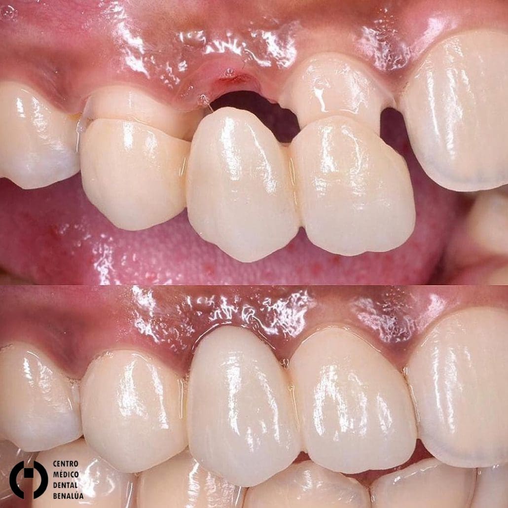 estetica dental carillas dentales antes y despues de paciente en clinica dental bnealua