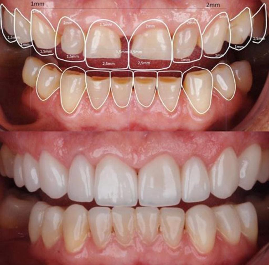 estetica dental clinica dental benalua antes y despues