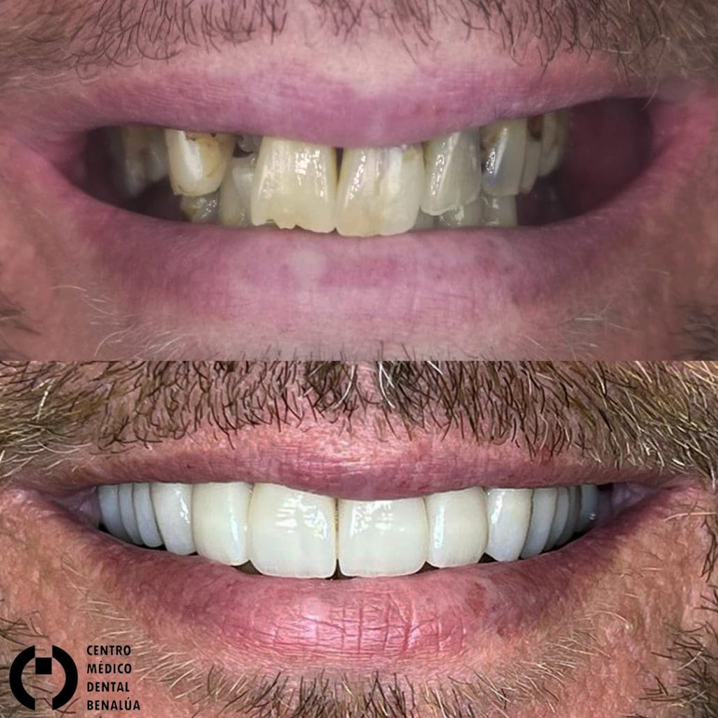estetica dental diseno de sonrisa antes y despues de paciente en clinica dental bnealua