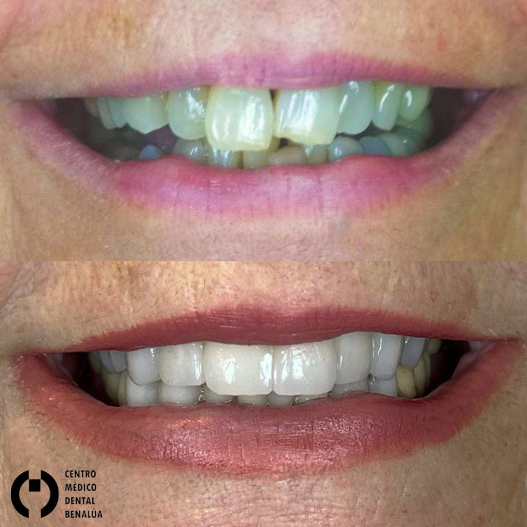 estetica dental sonrisa a medida antes y despues de paciente en clinica dental bnealua