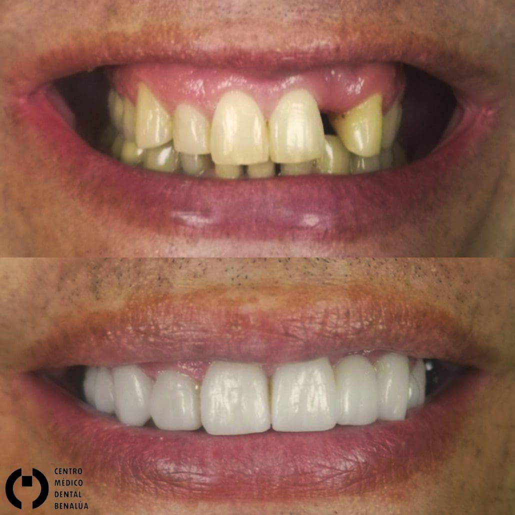 sonrisa estetica dental en clinica dental benalua antes y despues