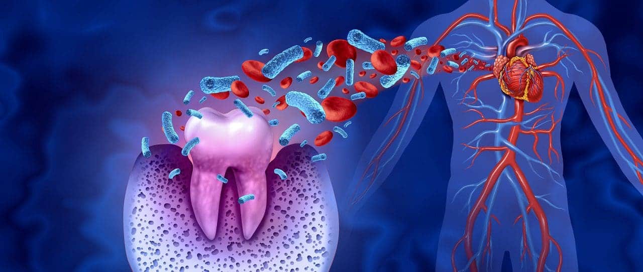 Caries dental y enfermedades del corazón