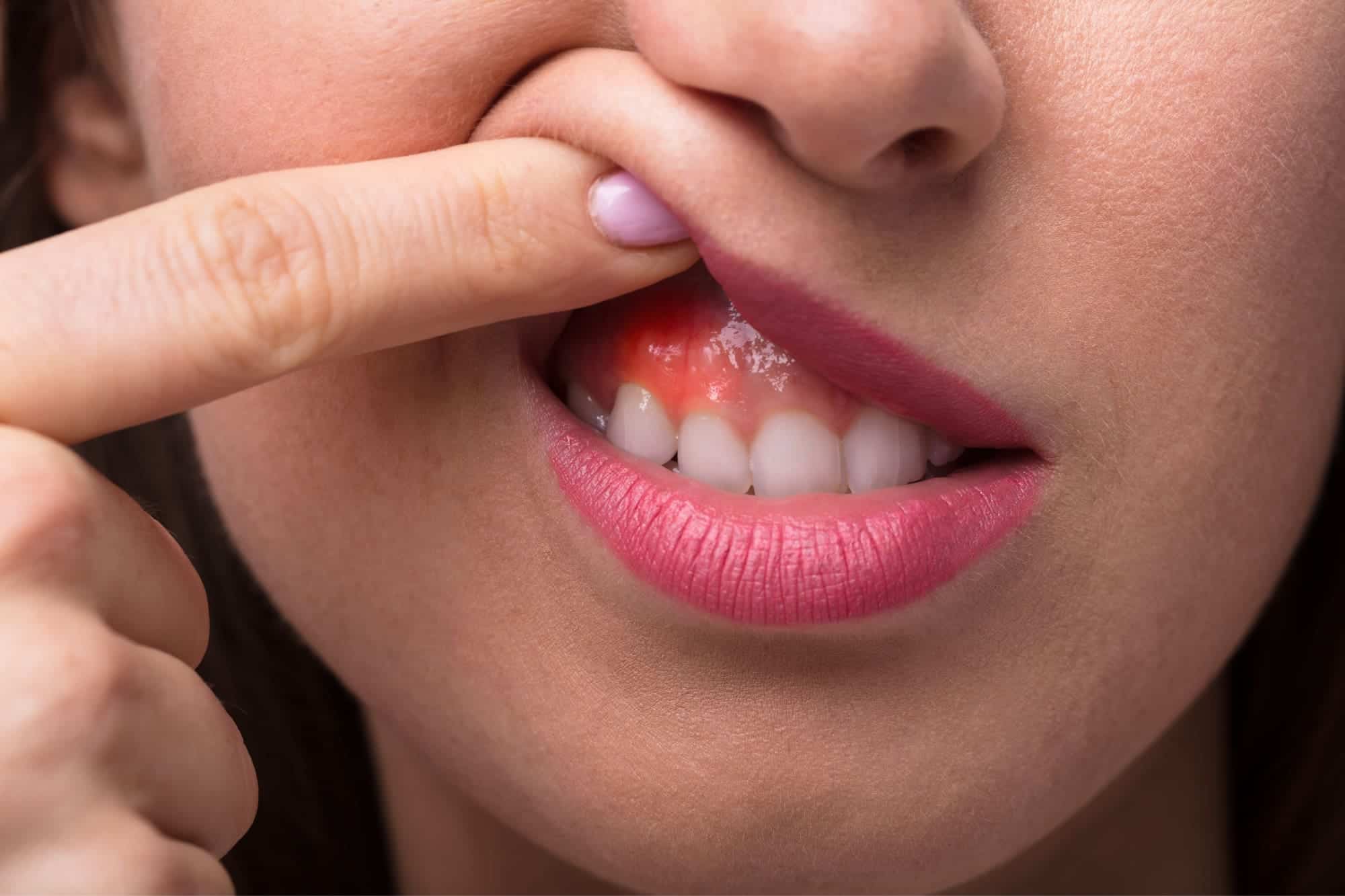 encías hinchadas - limpieza dental profesional