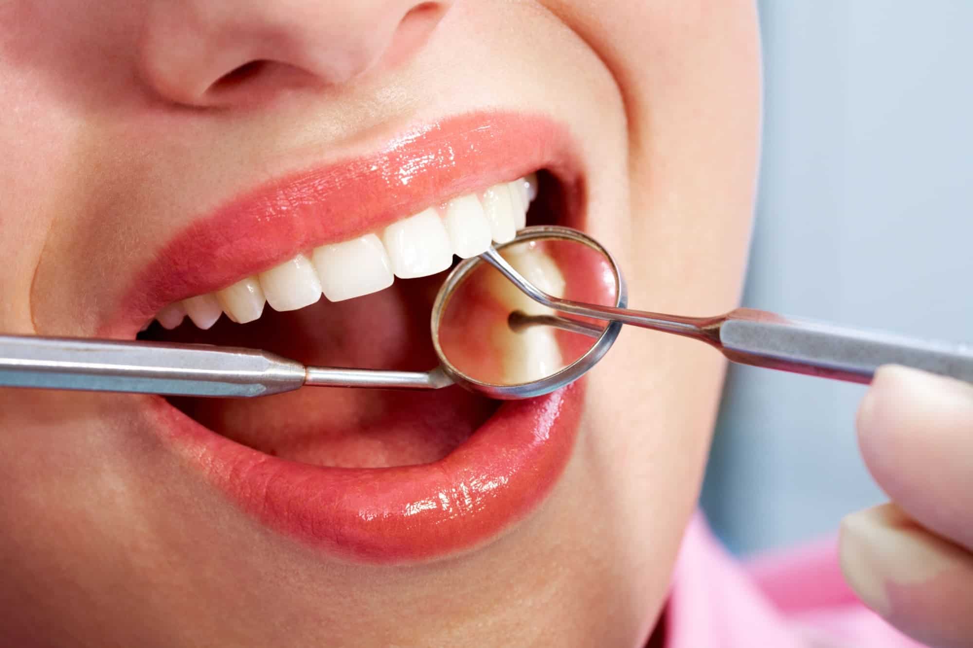 limpieza dental profesional en clinica dental Benalúa