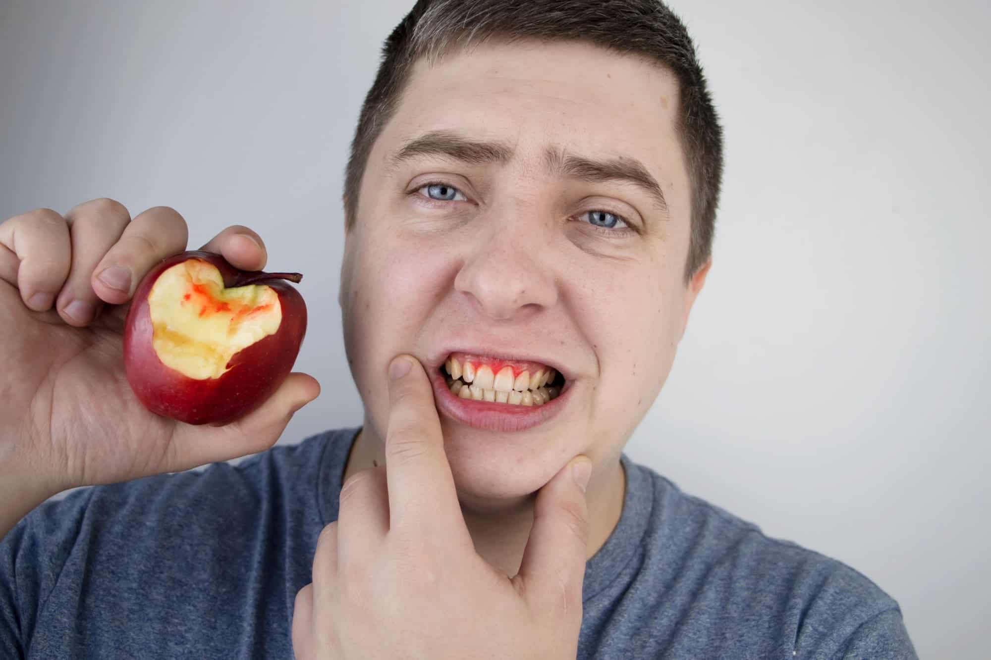 sangrado de encías - limpieza dental profesional