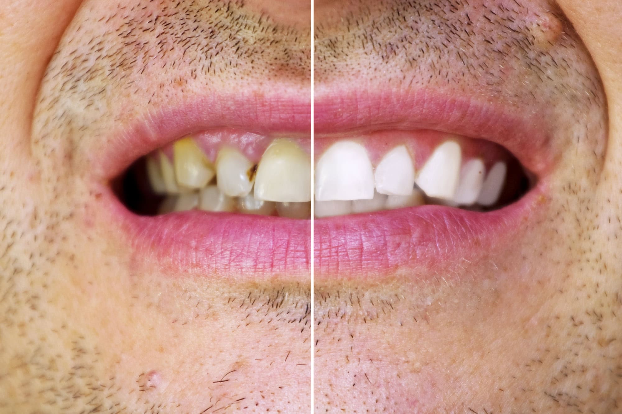 blanqueamiento dental - tendencias en estética dental 2024