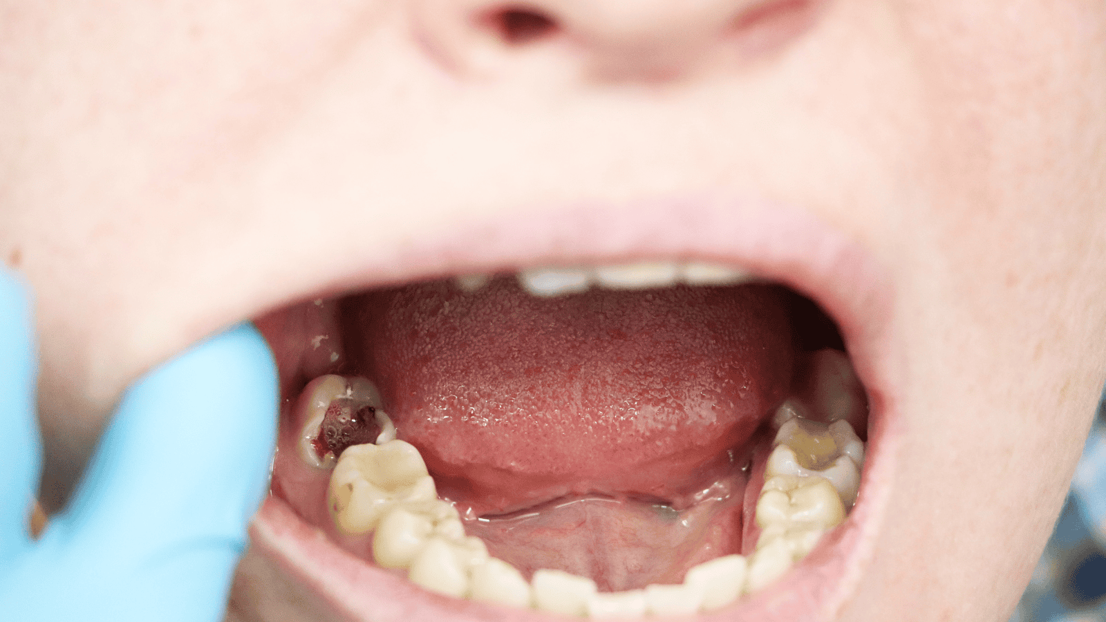 prevención de caries