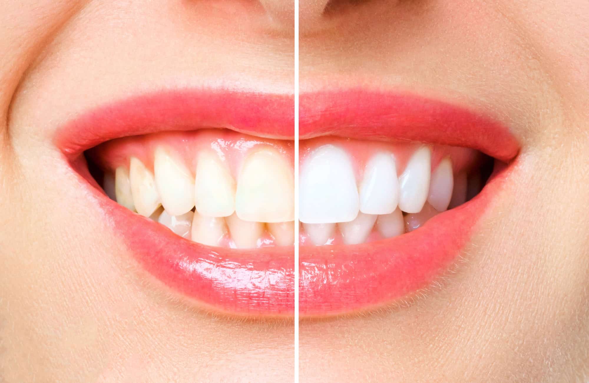 Blanqueamiento Dental Avanzado