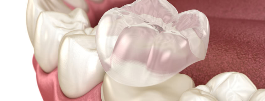 Materiales Biocompatibles en Odontología