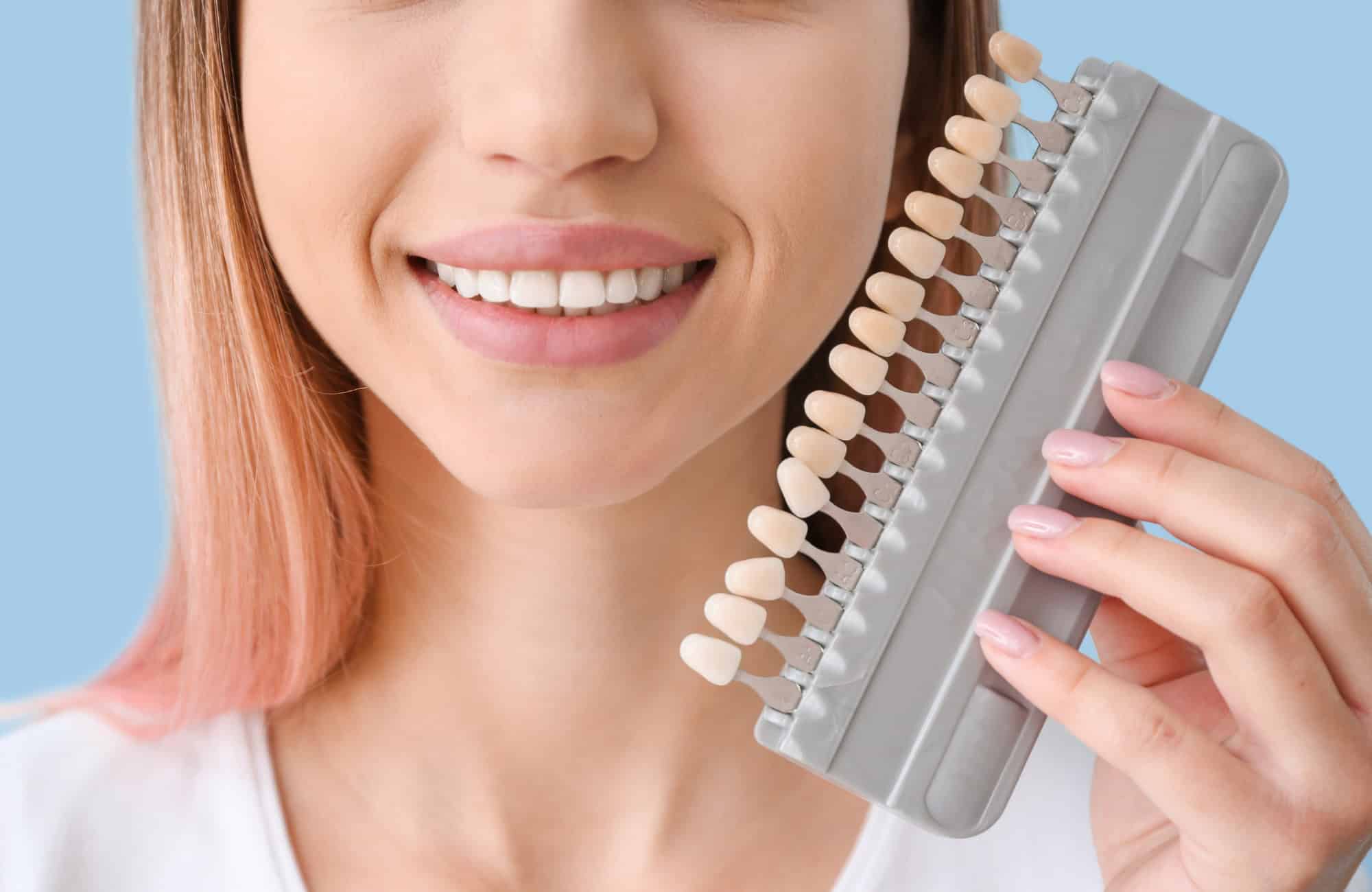carillas dentales composite