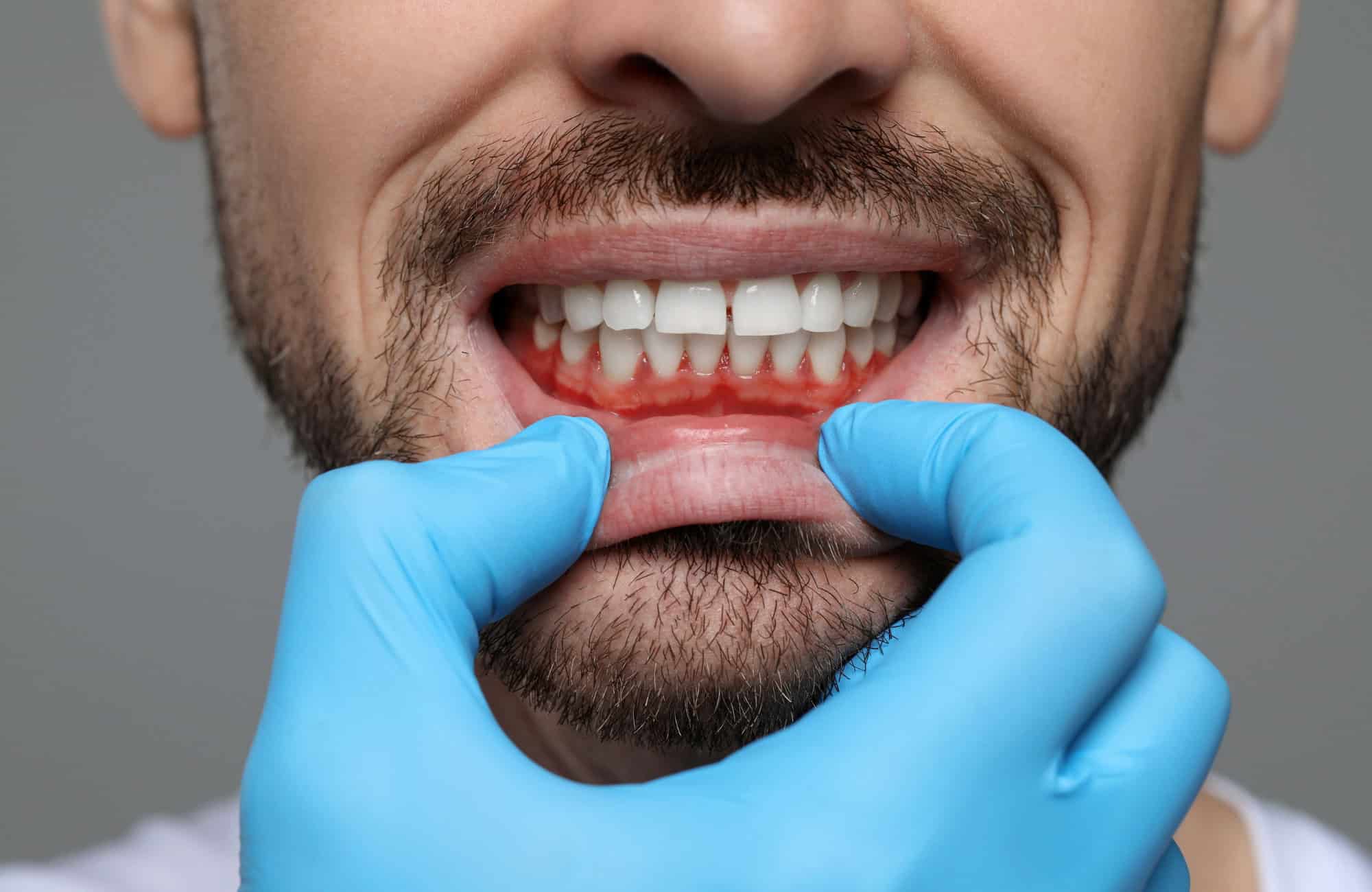 El Rol de la Genética en la Salud Dental 18 enfermedad periodontal