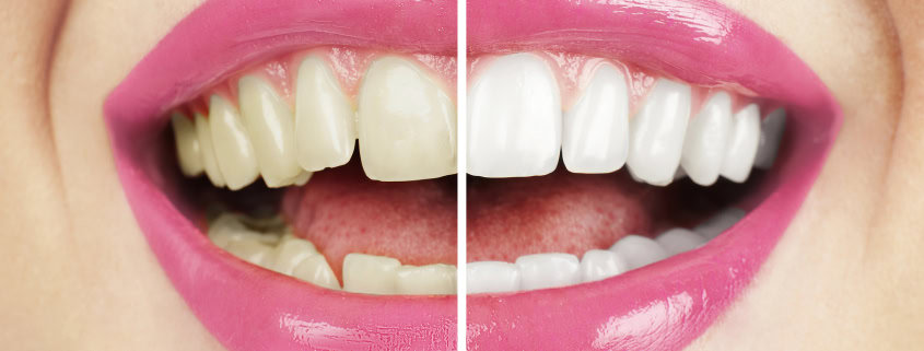 ¿Cómo Limpiar Dientes Amarillos? 15 limpiar dientes amarillos