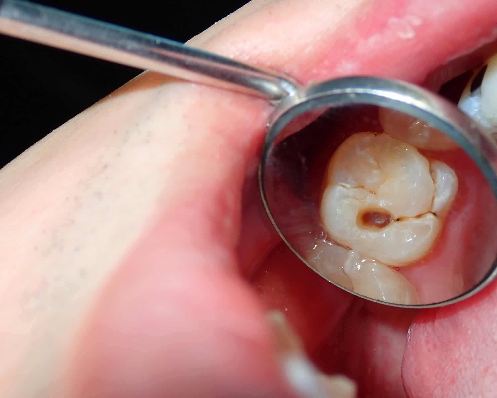 Importancia de las revisiones dentales post-vacaciones: Protege tu sonrisa después del verano 19 revisión dental para tratar caries