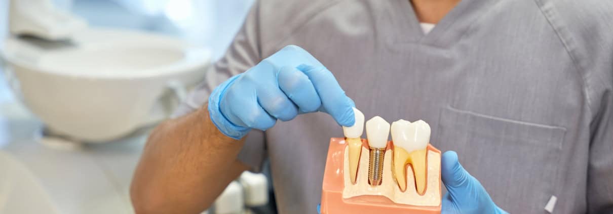 Implantes dentales vs. prótesis tradicionales: ¿Cuál es la mejor opción? 1 Implantes dentales vs. prótesis tradicionales