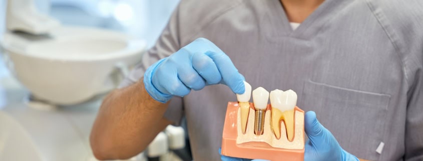 Implantes dentales vs. prótesis tradicionales: ¿Cuál es la mejor opción? 7 Implantes dentales vs. prótesis tradicionales