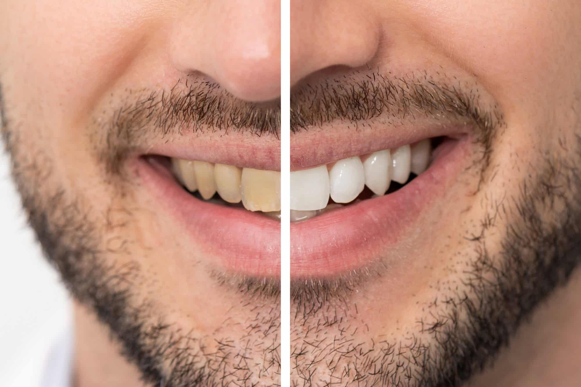 ¿Cómo prevenir la decoloración de los dientes a lo largo de los años? 13 Prevenir la decoloración de los dientes