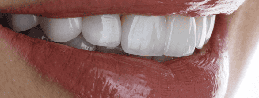 Tendencias en odontología cosmética: lo último en carillas y alineadores invisibles 5 Tendencias en odontología cosmética