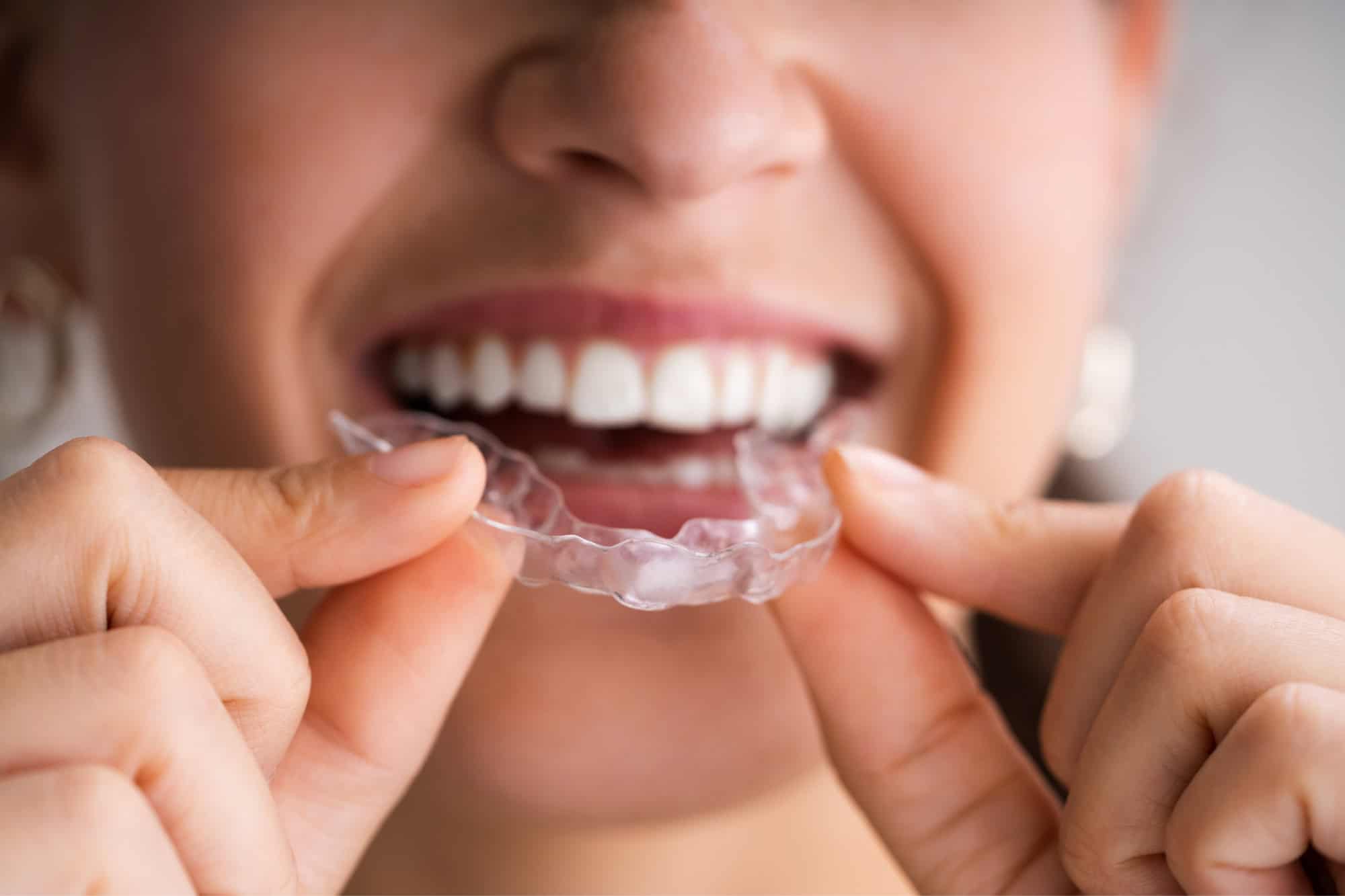 Tendencias en odontología cosmética: lo último en carillas y alineadores invisibles 6 alineadores invisibles invisalign carillas