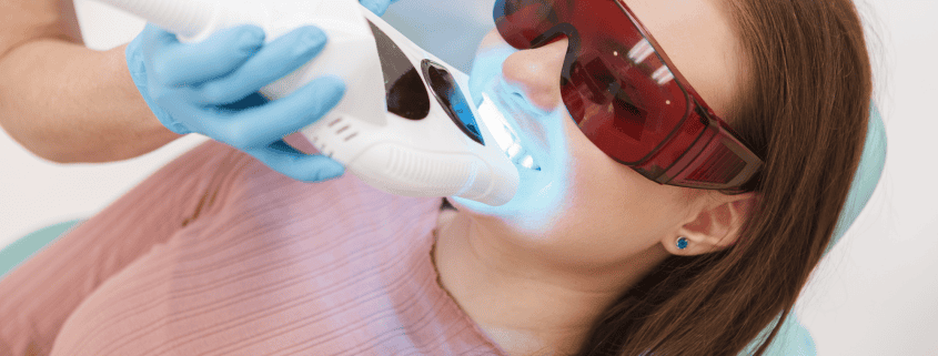 La Importancia del Blanqueamiento Dental Profesional frente a los Métodos Caseros 11 blanqueamiento dental profesional
