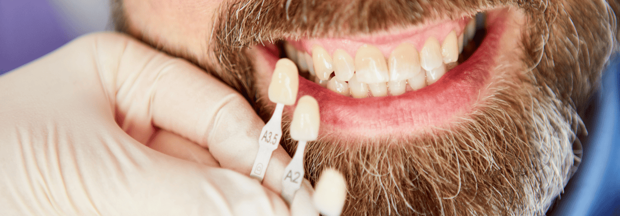 decoloración dental
