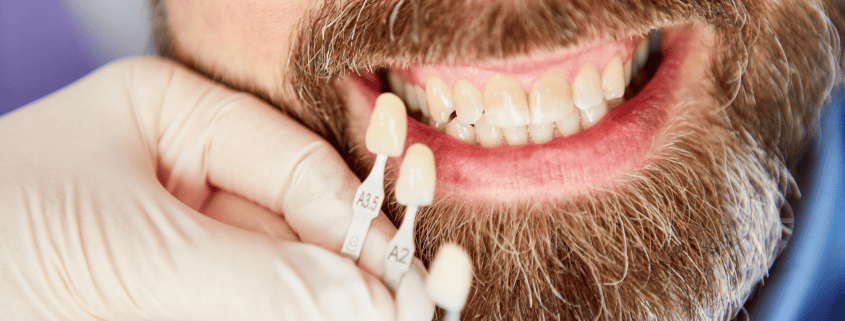 ¿Cómo prevenir la decoloración de los dientes a lo largo de los años? 12 decoloración dental