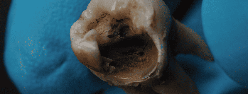 Causas y Tratamiento de los Dientes Negros 14 diente negro