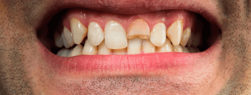 ¿Qué hacer ante una emergencia dental? Guía práctica para el día a día 8 emergencia dental