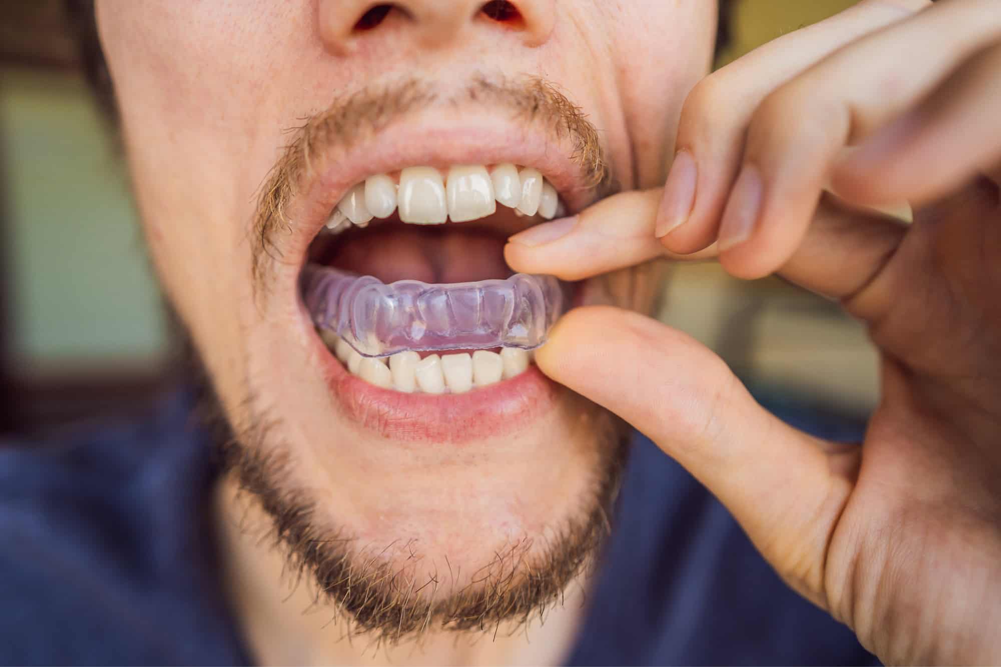 El impacto del bruxismo en la salud dental y cómo tratarlo 2 férula bruxismo