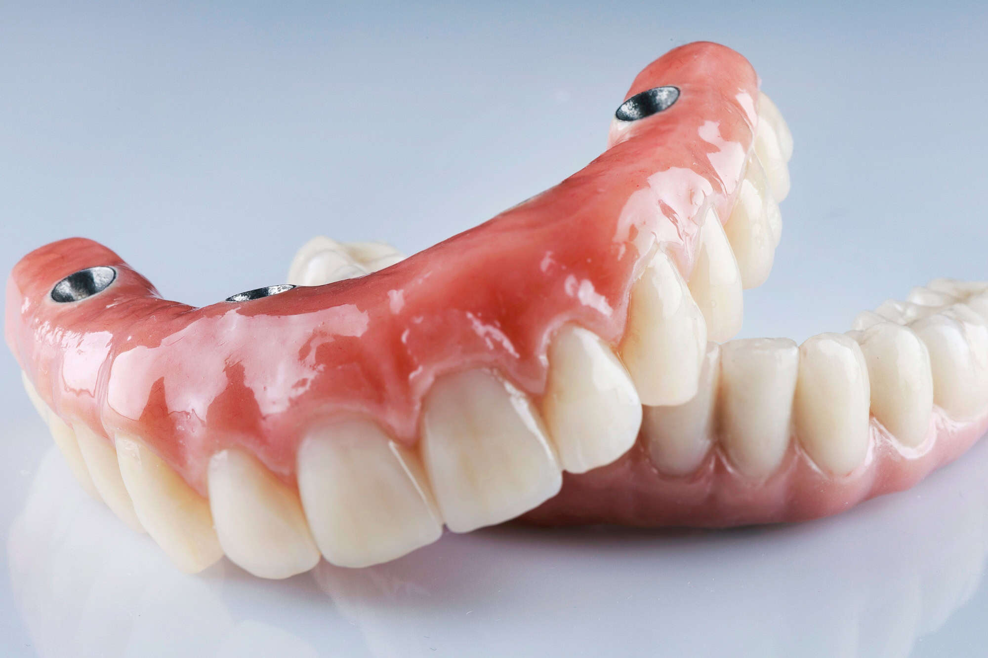 Implantes dentales vs. prótesis tradicionales: ¿Cuál es la mejor opción? 2 prótesis tradicionales