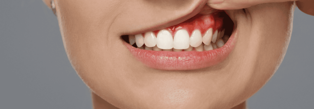 Enfermedad periodontal encías inflamadas y sangrantes