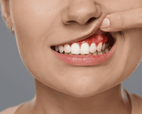 Enfermedad periodontal encías inflamadas y sangrantes