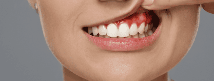 Enfermedad periodontal encías inflamadas y sangrantes