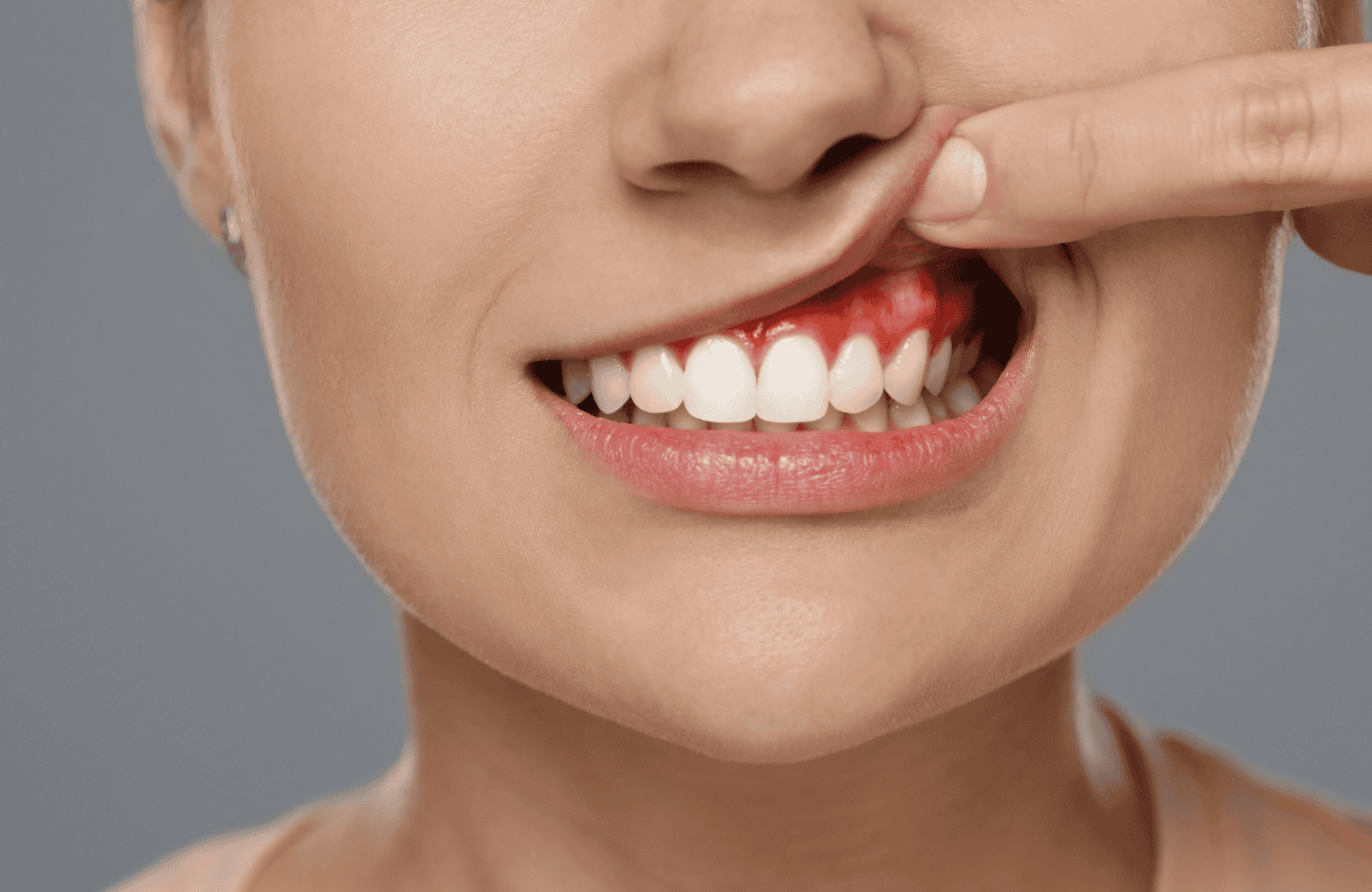 La relación entre salud oral y enfermedades cardíacas 3 Encías inflamadas y sangrantes