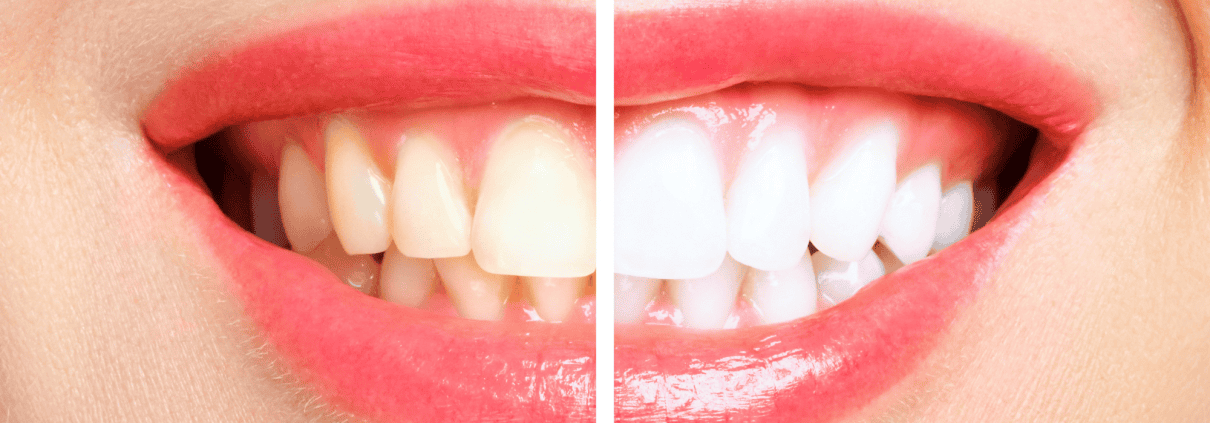 Comparativa antes y después de blanqueamiento dental en Alicante mostrando el aclaramiento de varios tonos