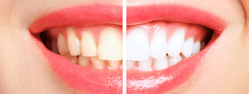 Blanqueamiento dental: Mitos y realidades 5 Comparativa antes y después de blanqueamiento dental en Alicante mostrando el aclaramiento de varios tonos