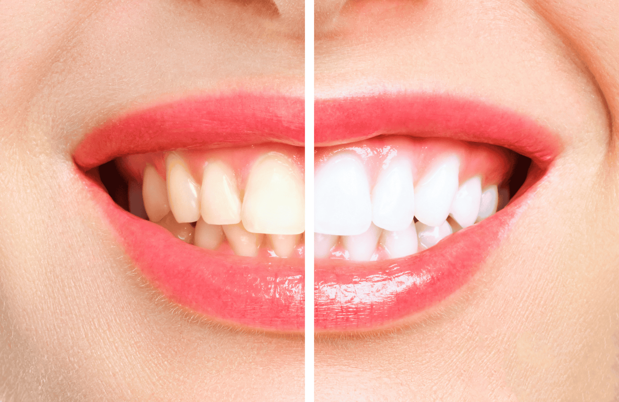 Comparativa antes y después de blanqueamiento dental en Alicante mostrando el aclaramiento de varios tonos