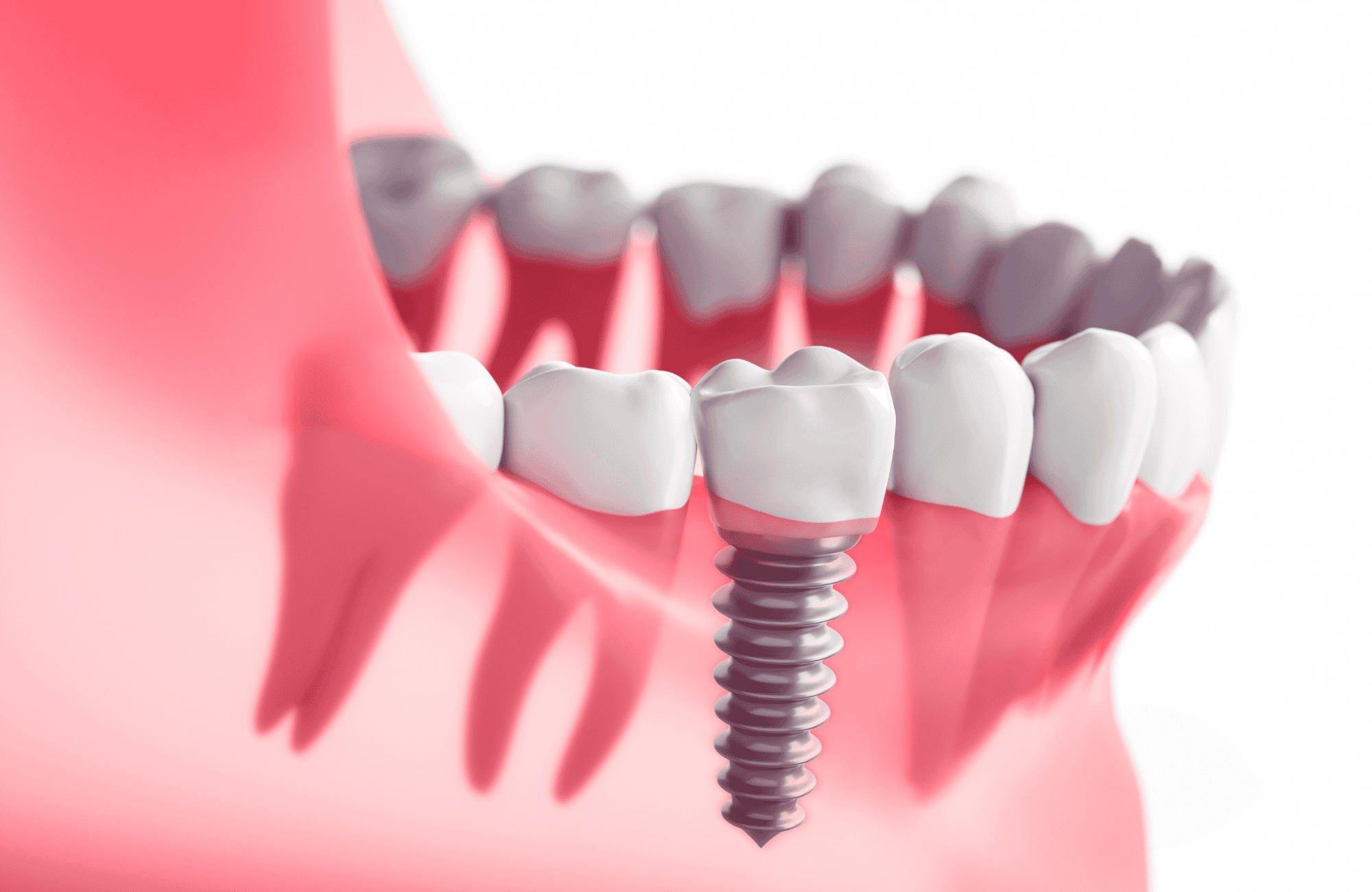Dentaduras postizas vs. Implantes: ¿Cuál es la mejor opción? 6 implante dental diseño 3d