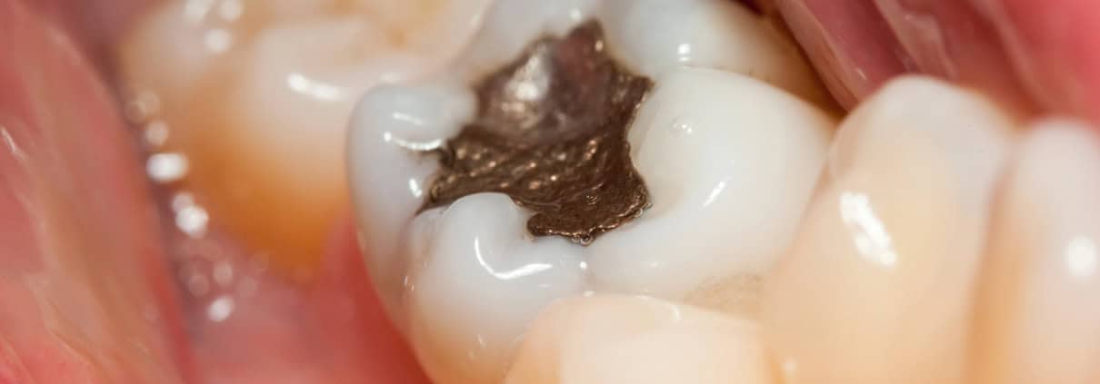 Amalgamas Dentales con Mercurio