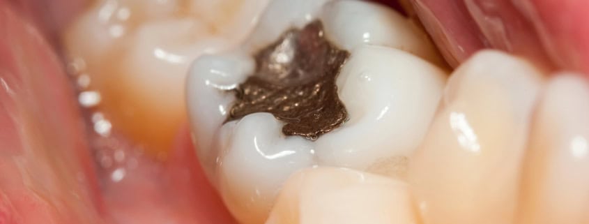 La Prohibición de Amalgamas Dentales con Mercurio en la UE: Implicaciones y Alternativas 11 Amalgamas Dentales con Mercurio