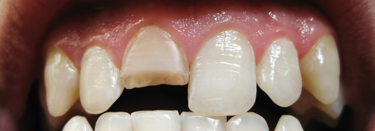 Fractura dental primeros auxilios