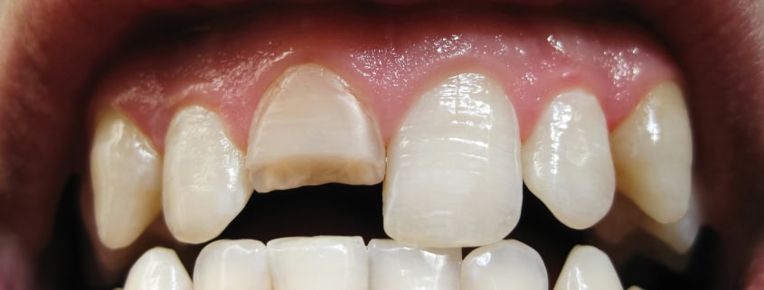 ¿Qué Hacer si se Rompe o Astilla un Diente? Guía de Primeros Auxilios Dentales 17 Fractura dental primeros auxilios