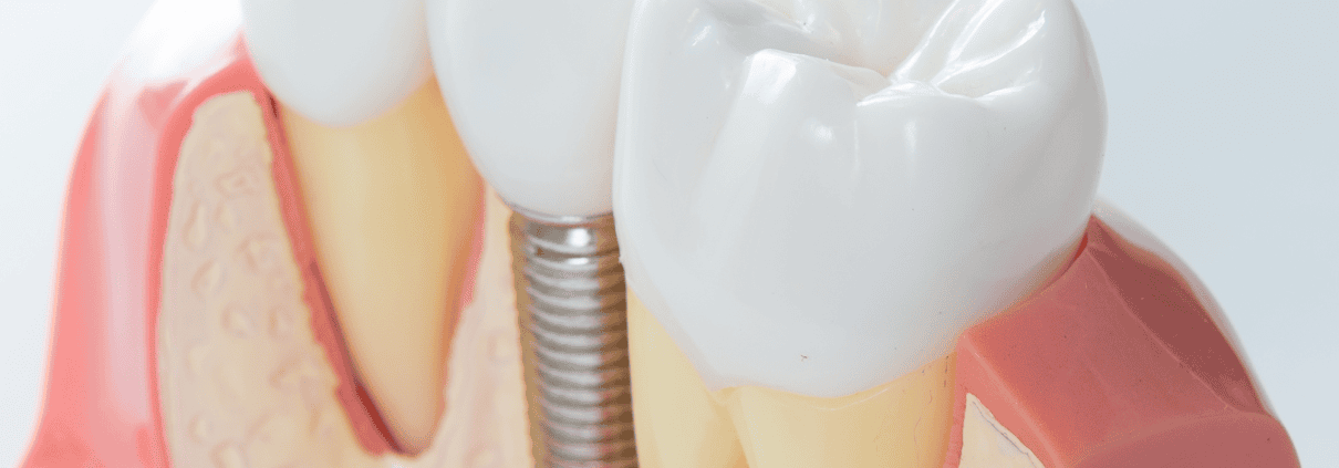 Implantología 3D: Revolucionando la Reposición Dental 1 Implantología 3D
