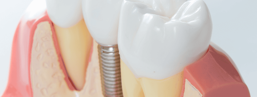 Implantología 3D: Revolucionando la Reposición Dental 5 Implantología 3D